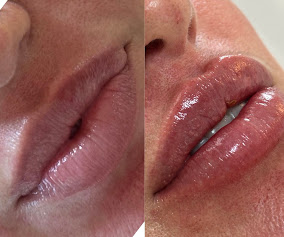 Antes e depois de preenchimento labial feito na Exclusiv